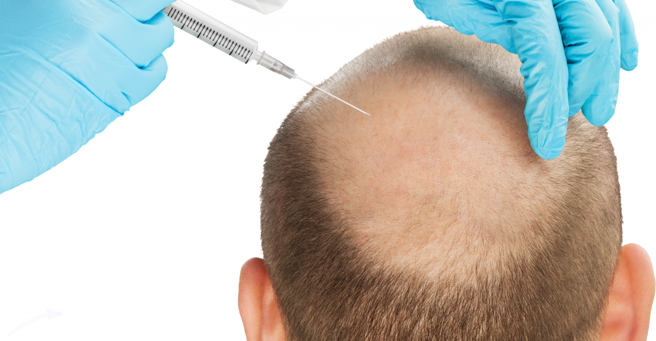 Los efectos de los medicamentos en la caída del cabello