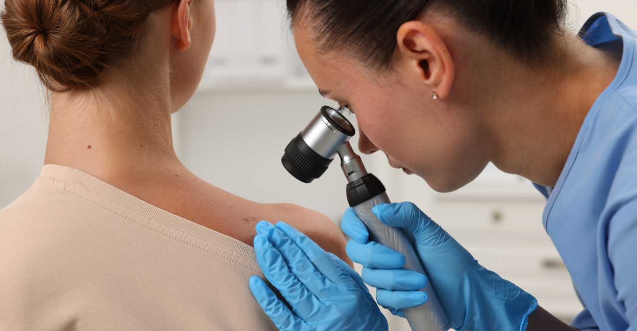 Melanoma el cáncer de piel